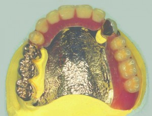 [症例1]上下多数歯欠損症例 | 森本歯科医院
