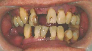 歯科難症例治療システムとしてのコーヌステレスコープ 概略編 | 森本 