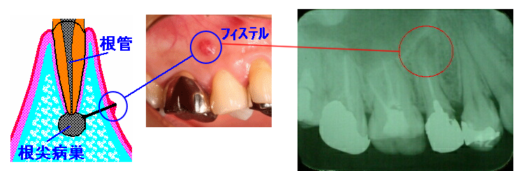 根管治療 森本歯科医院